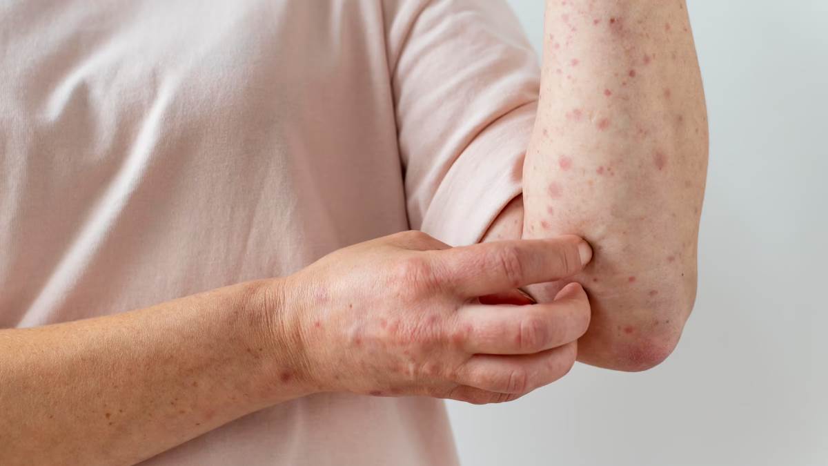 Skin Infection: एक से दूसरे में फैलने वाला खतरनाक इंफेक्शन है स्कैबीज, बड़े  ही नहीं बच्चे तक हो सकते हैं शिकार - Skin Infection Everything You Need to  Know About Scabies its