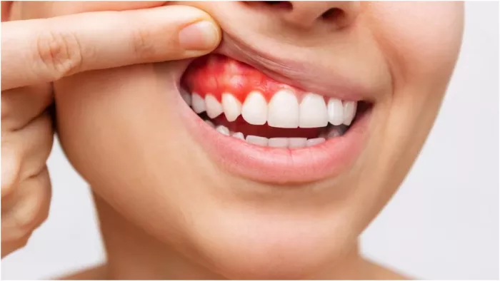 मसूड़ों के अलग-अलग रंग के पीछे है अलग-अलग वजह