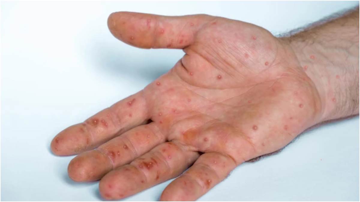 Monkeypox Symptoms: मंकीपॉक्स के दो नए लक्षणो के बारे में जानते हैं आप?