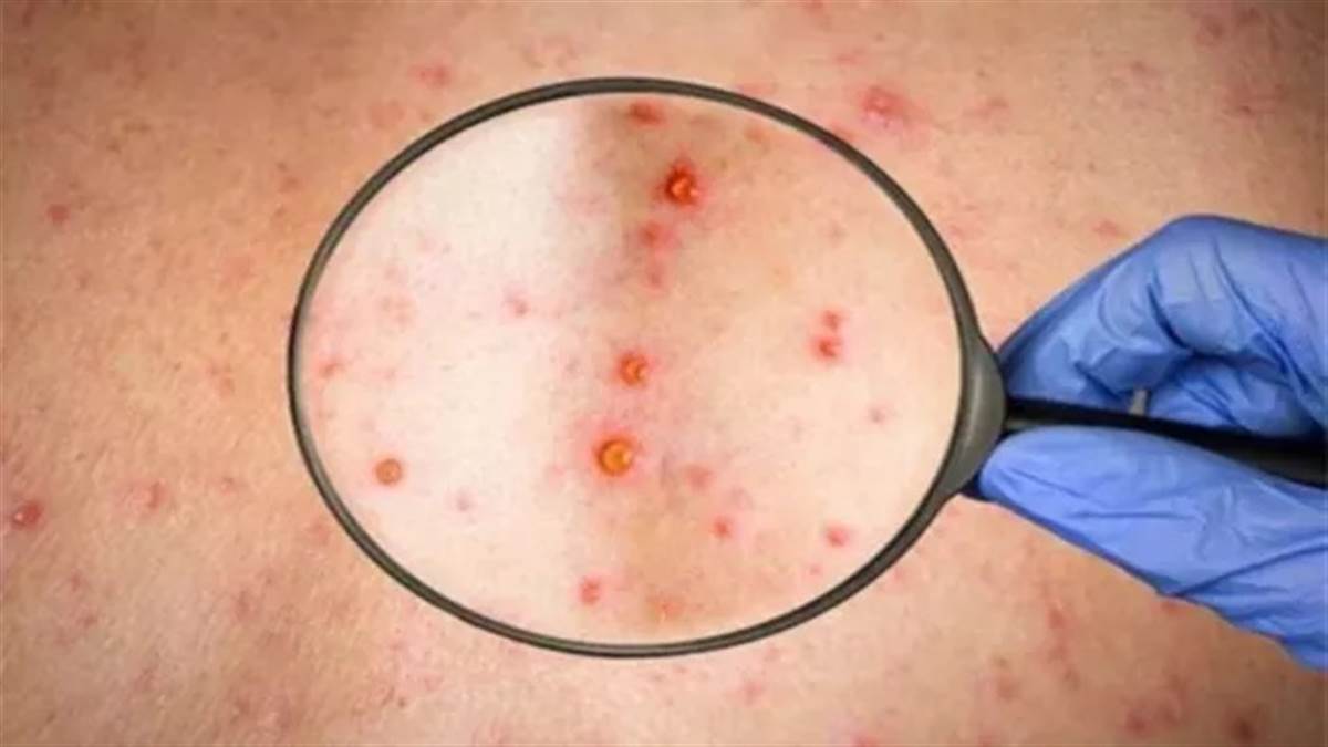 https://www.jagranimages.com/images/newimg/09092024/09_09_2024-monkeypox_mpox_23794060.jpg