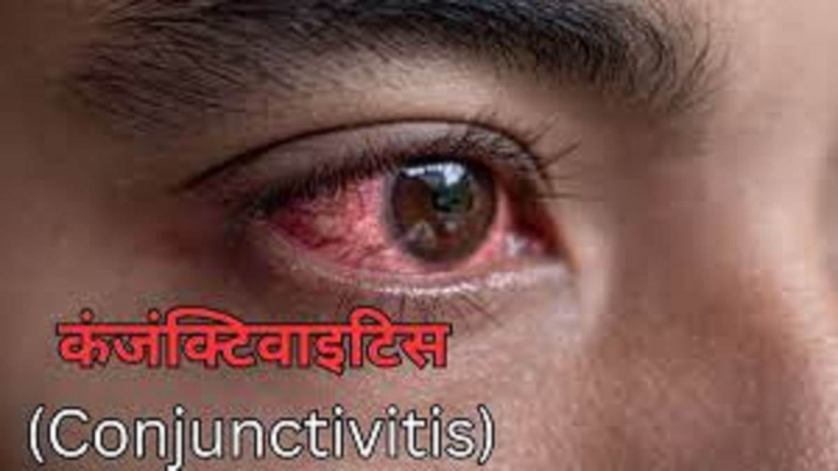 https://www.jagranimages.com/images/newimg/09092025/09_09_2025-conjunctivitis_24040952.jpg