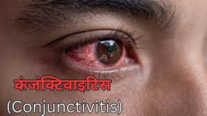 गंगा-यमुना में बाढ़ के कारण प्रयागराज में कंजक्टिवाइटिस का खतरा बढ़ गया है।