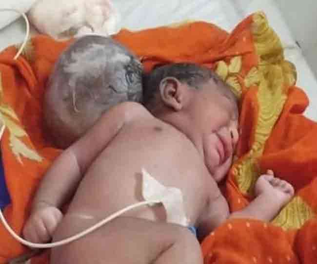two headd baby girl born in the hospital people were stunned to see the newborn