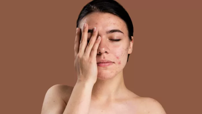 World Lupus Day: ल्यूपस बीमारी के कारण लक्षण व उपचार