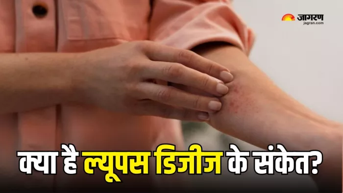 क्यों मनाया जाता है World Lupus Day और क्या हैं इसके लक्षण? (Picture Courtesy: Freepik)