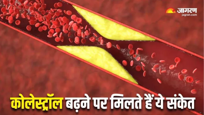 कोलेस्ट्रॉल से याददाश्त पर असर। जागरण (सांकेतिक तस्वीर)