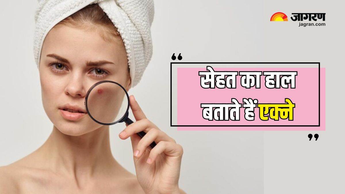 https://www.jagranimages.com/images/newimg/10062024/10_06_2024-acne_on_face_23735996_15375123.jpg