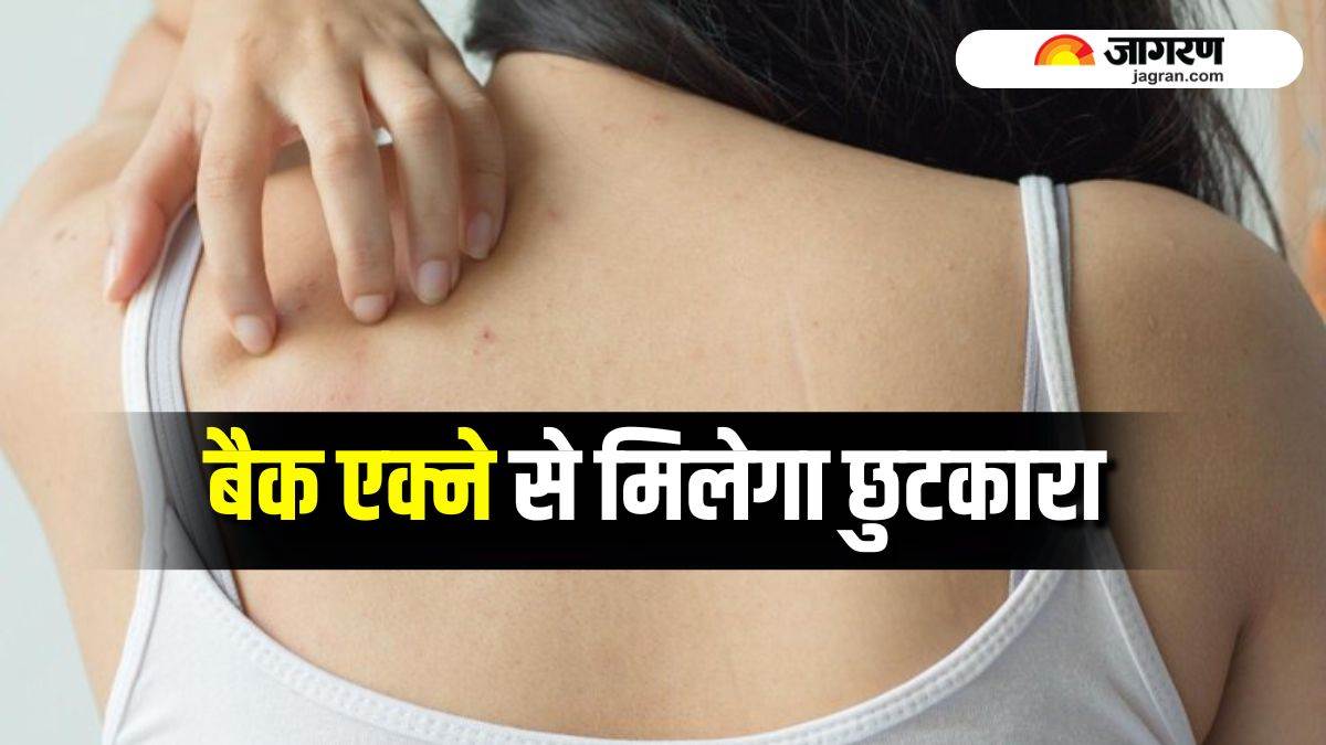 https://www.jagranimages.com/images/newimg/10062025/10_06_2025-back_acne_relief_tips_23960382.jpg