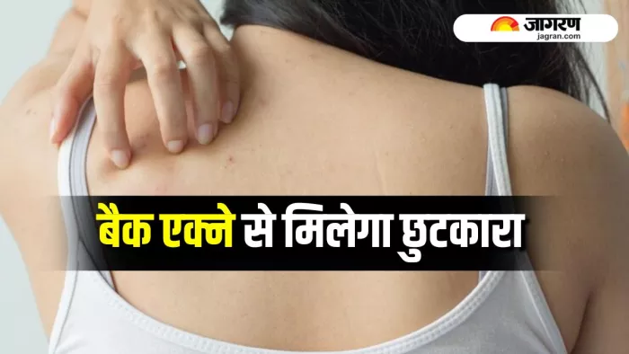 Back Acne से राहत दिला सकते हैं डर्मेटोलॉजिस्ट के 4 टिप्स (Image Source: Freepik)
