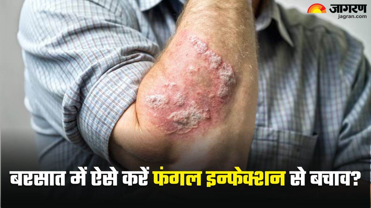 https://www.jagranimages.com/images/newimg/10072025/10_07_2025-fungal_infection_prevention_23980340.jpg