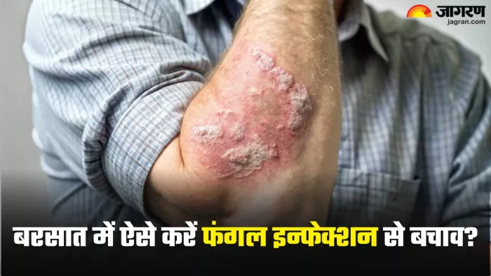 मानसून में फंगल इन्फेक्शन से कैसे बचें? (Picture Credit- Freepik)