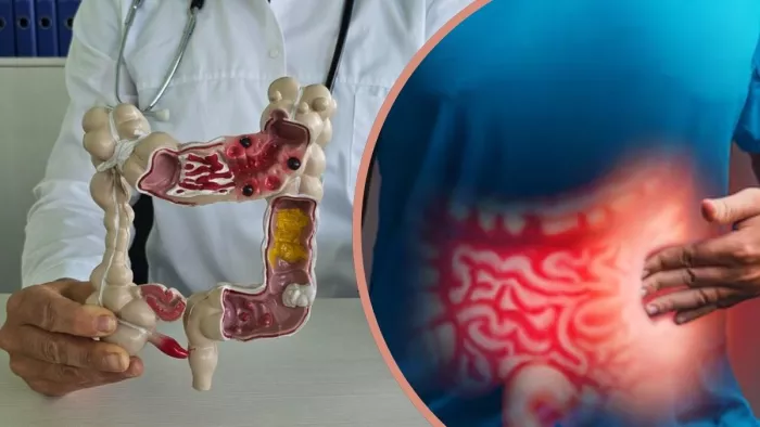 क्या है IBS और Colon Cancer (Image Credit- Freepik)