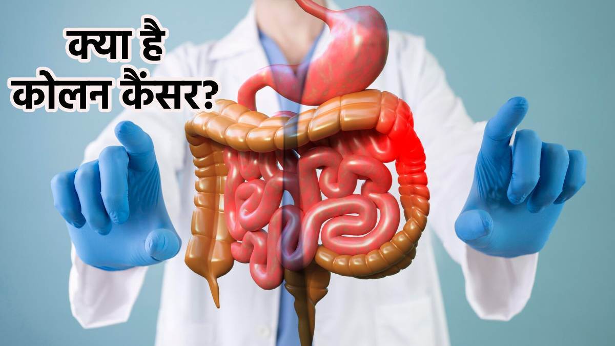colon cancer causes symptoms treatment and prevention