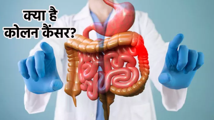 Colon Cancer: क्या है कोलन कैंसर, इसके लक्षण व बचाव