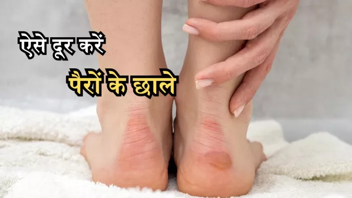 नए फुटवियर से हो गए हैं छाले, तो ऐसे करें ठीक