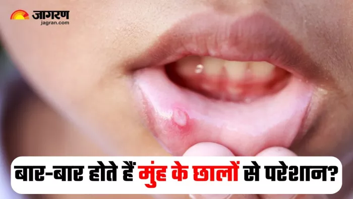 Mouth Ulcer: बार-बार मुंह में हो रहे हैं छाले, तो इन 5 समस्याओं का हो सकता है इशारा (Image: Freepik)