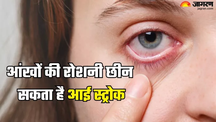 जानें क्या है आई स्ट्रोक और इसके लक्षण (Picture Credit- Freepik)