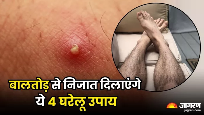 बालतोड़ को ठीक करने के लिए बेहद कारगर हैं ये 4 घरेलू नुस्खे (Image Source: Freepik)