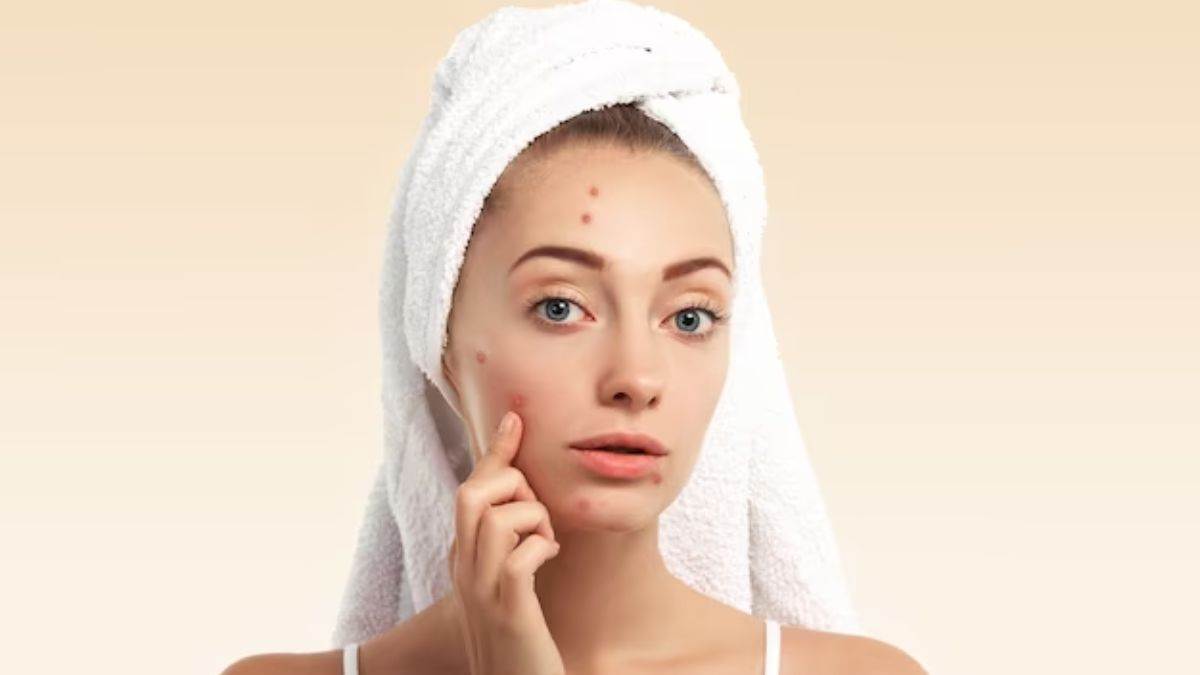 these foods can cause acne avoid them for clear and glowing skin