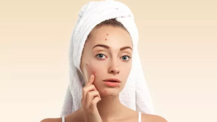 Acne Causes: ये फूड्स बन सकते हैं एक्ने की वजह! (Picture Courtesy: Freepik)