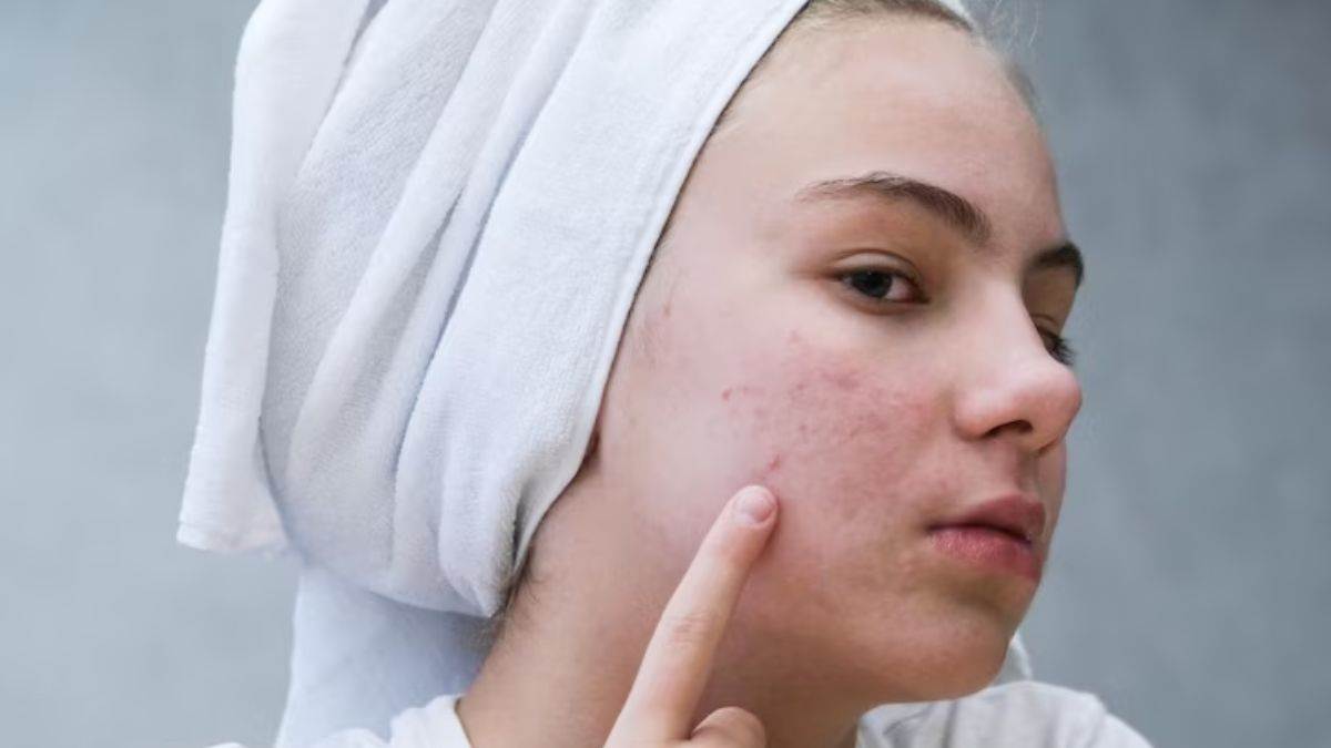 https://www.jagranimages.com/images/newimg/11062023/11_06_2023-acne_23438718.jpg