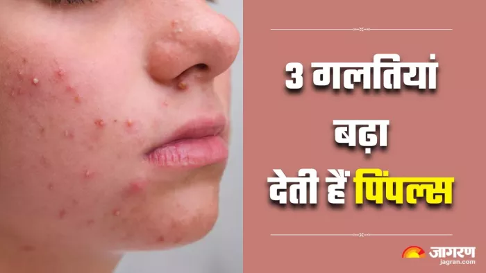 पिंपल्स को बढ़ाने के पीछे जिम्मेदार हो सकती हैं 3 गलतियां (Image Source: Freepik)