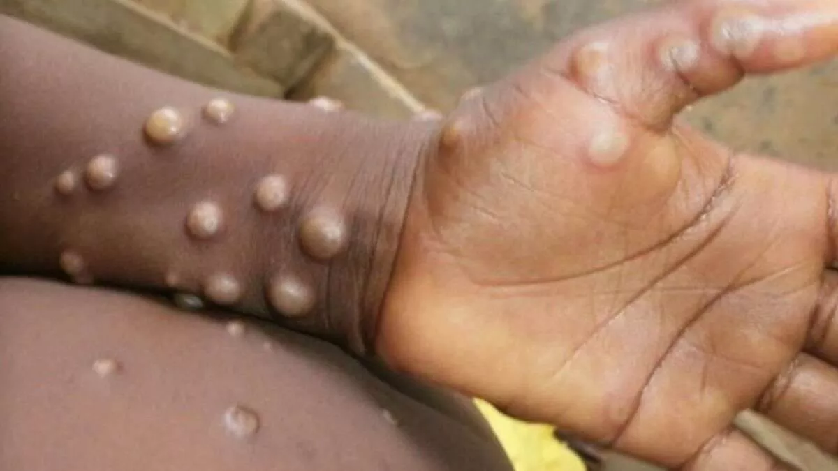 Monkeypox को लेकर परेशान हुआ अफ्रीका, लाखों को नहीं मिल पाया है वैक्‍सीन का एक भी डोज, टीके पर जोरो-शोरो से हो रही चर्चा