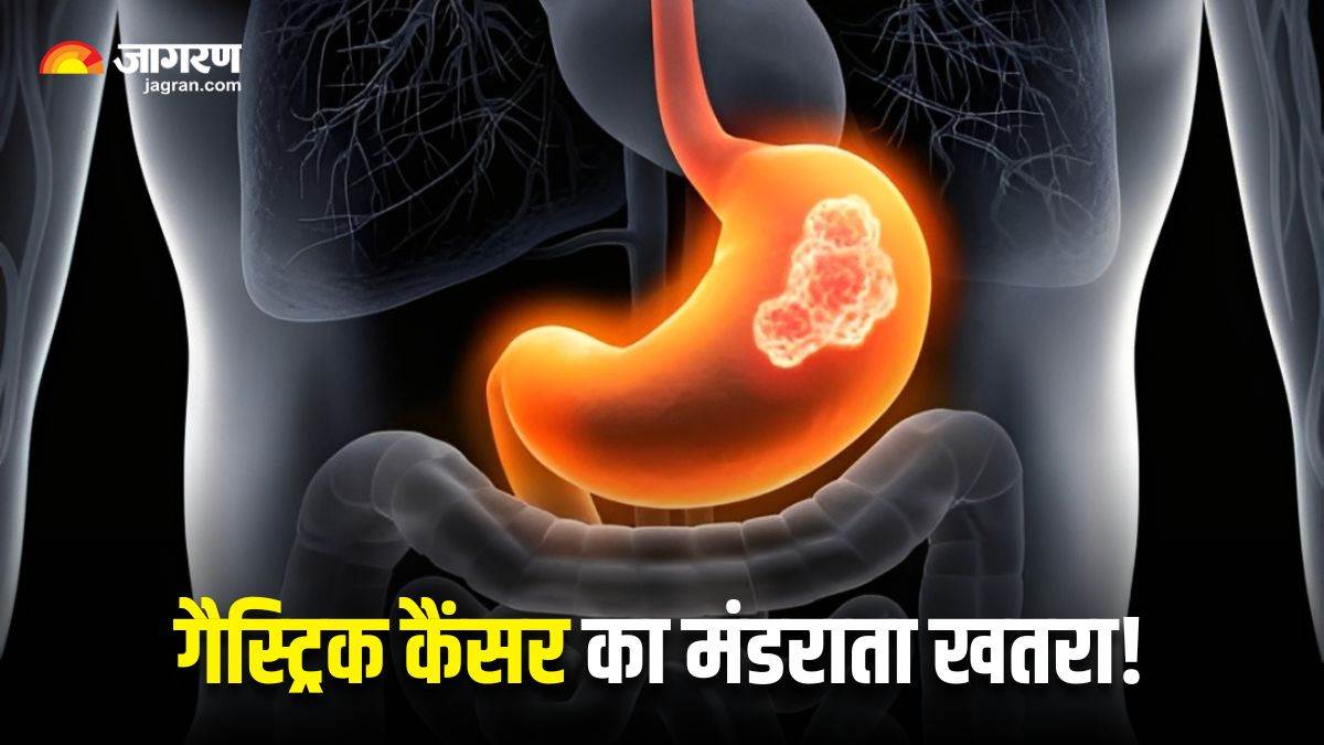 https://www.jagranimages.com/images/newimg/11082025/11_08_2025-gastric_cancer_india_24009537.jpg