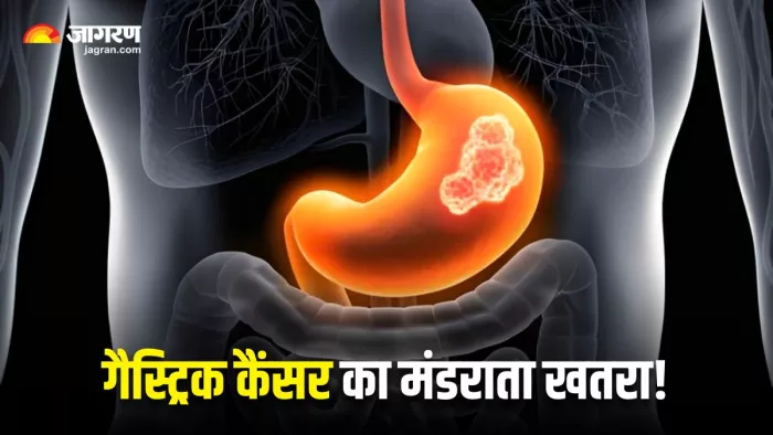 गैस्ट्रिक कैंसर के मामलों में दुनिया में दूसरे नंबर पर पहुंचा भारत (Image Source: Freepik)