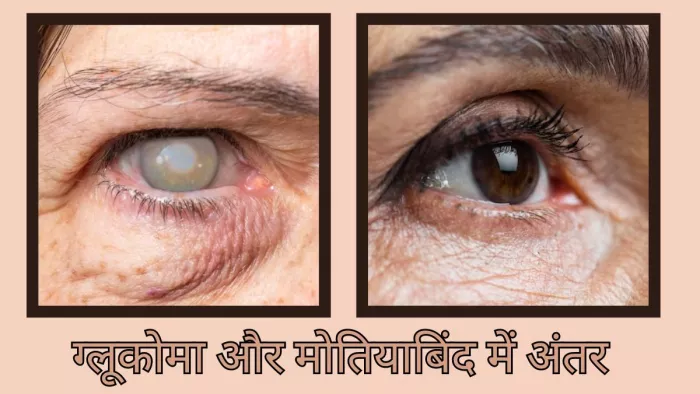 क्या आप जानते हैं ग्लूकोमा और मोतियाबिंद में अंतर