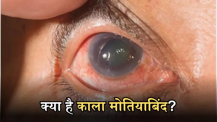 आंखों की रोशनी छीन लेता है ये रोग, वक्त रहने अलर्ट हो जाने में है समझदारी