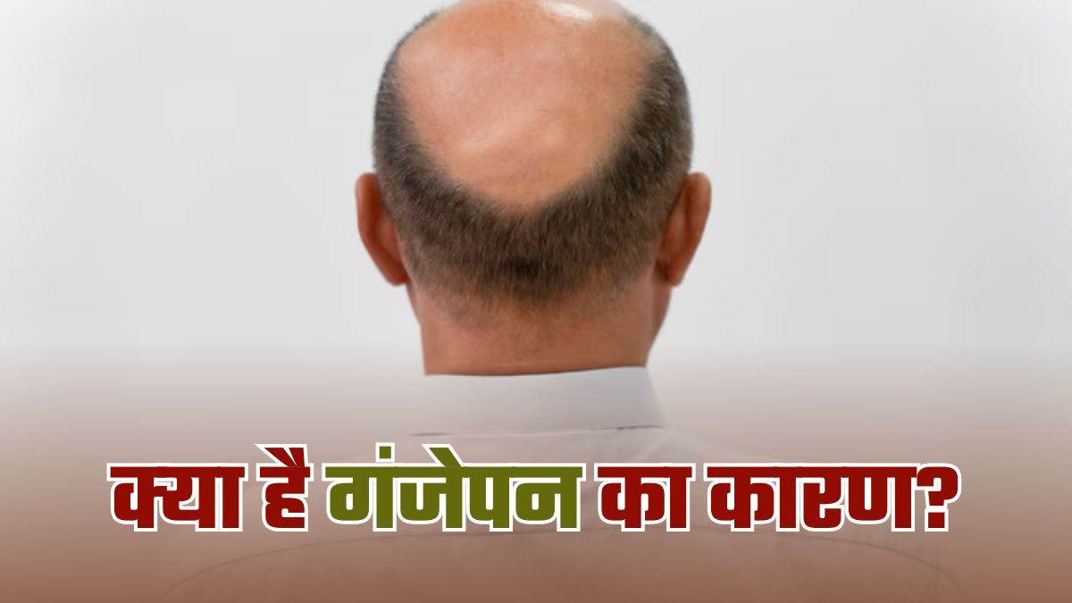 https://www.jagranimages.com/images/newimg/12052025/12_05_2025-baldness_23936147.jpg