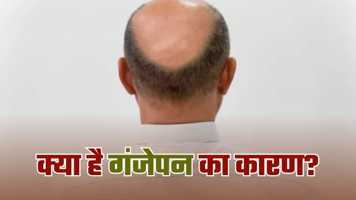 गंजेपन से निजात दिलाएंगे ये टिप्स। (Image Credit- Freepik)