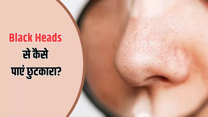 Black Heads से छुटकारा दिलाएंगे ये नुस्खे (Image Credit- Freepik)