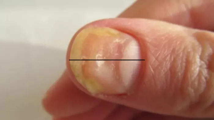 Yellow Nail Syndrome: पीले नाखून भी देते हैं बीमारियों के संकेत