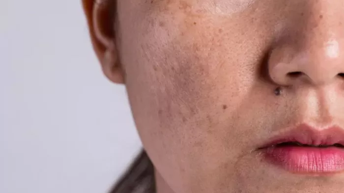 Pigmentation: चेहरे की झाइयों को दूर करने के लिए अपनाएं ये घरेलू उपाय