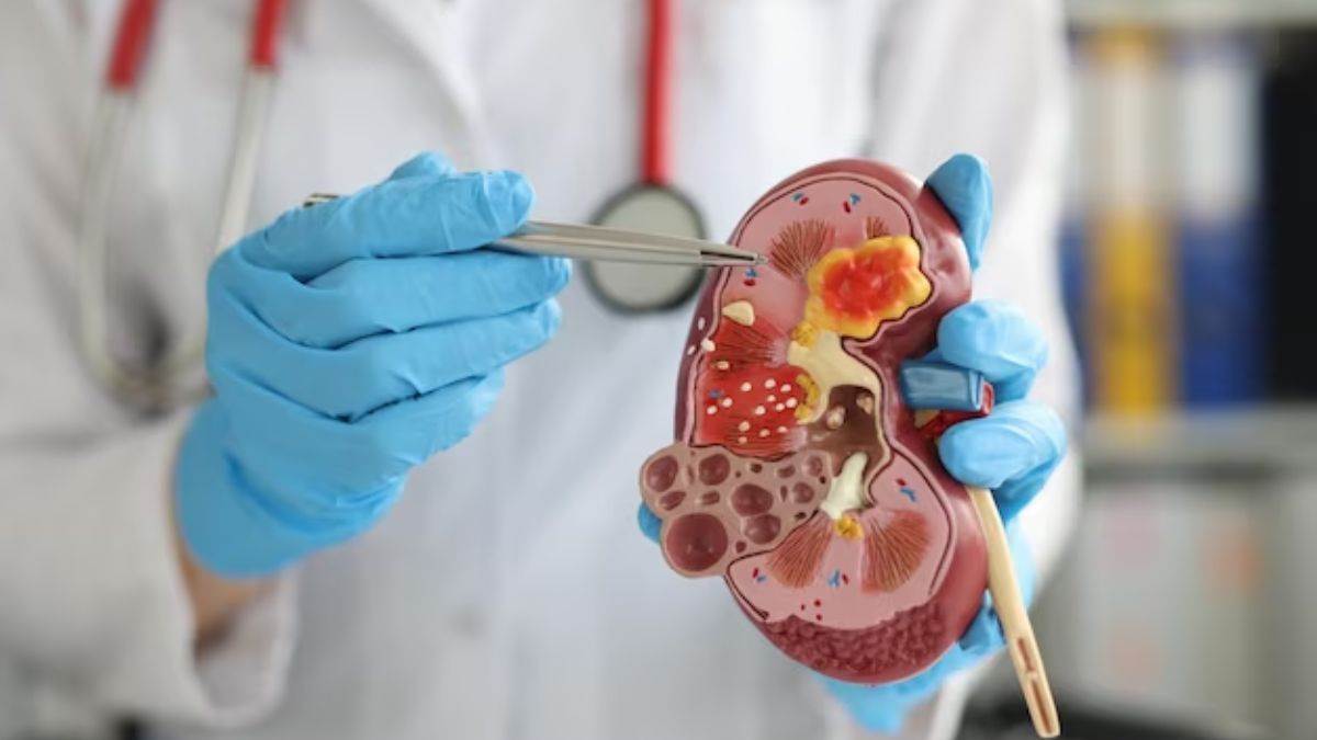 https://www.jagranimages.com/images/newimg/13032025/13_03_2025-kidney_damage_23899325.jpg