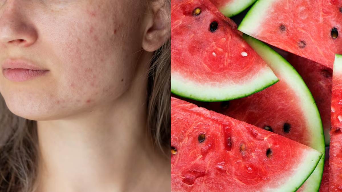 https://www.jagranimages.com/images/newimg/13042023/13_04_2023-acne_care_23384173.jpg