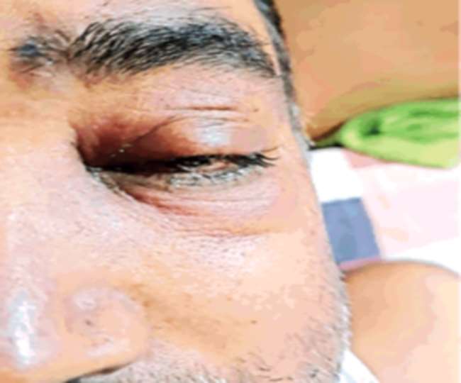 Alert Post Covid Disease Found In India Black Fungus Is Dangerous Health Nyoooz Alert Post Covid Disease Found In India Black Fungus Is Dangerous Health Nyoooz