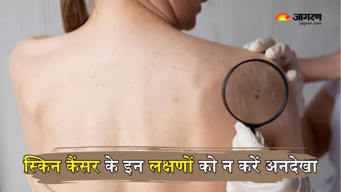Skin Cancer का वक्त रहते इलाज है जीवन के लिए वरदान (Picture Courtesy: Freepik)