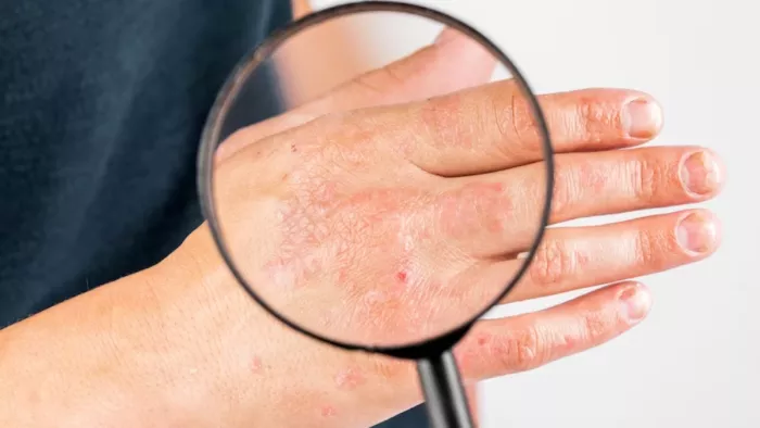 Fungal Infection: फंगल इन्फेक्शन दूर करने के टिप्स