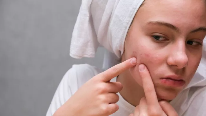 Winter Acne Causes: सर्दियों में इन वजहों से बढ़ जाती है पिंपल्स की सस्या।