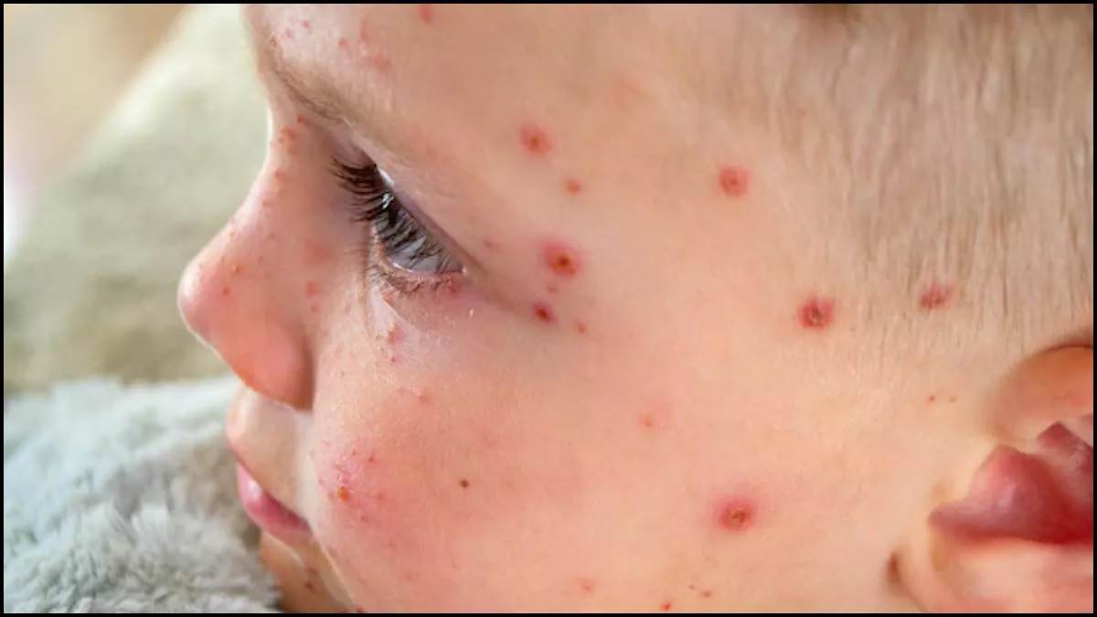 https://www.jagranimages.com/images/newimg/14032025/14_03_2025-measles_pic_23899856.jpg