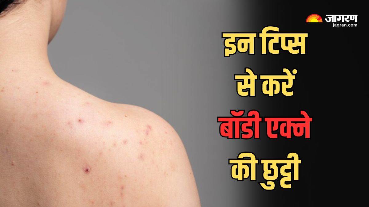 https://www.jagranimages.com/images/newimg/14042024/14_04_2024-body_acne_23696449.jpg