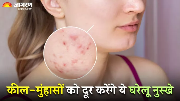 कील-मुंहासों को दूर करने के लिए अपनाएं ये घरेलू नुस्खे (Image Source: Freepik)
