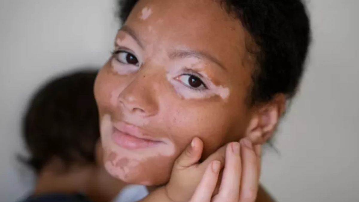 https://www.jagranimages.com/images/newimg/14082024/14_08_2024-vitiligo_23778011.jpg