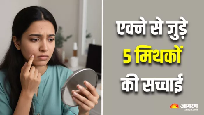 डर्मेटोलॉजिस्ट ने बताई एक्ने से जुड़े 5 मिथकों की सच्चाई (Image Source: AI-Generated)