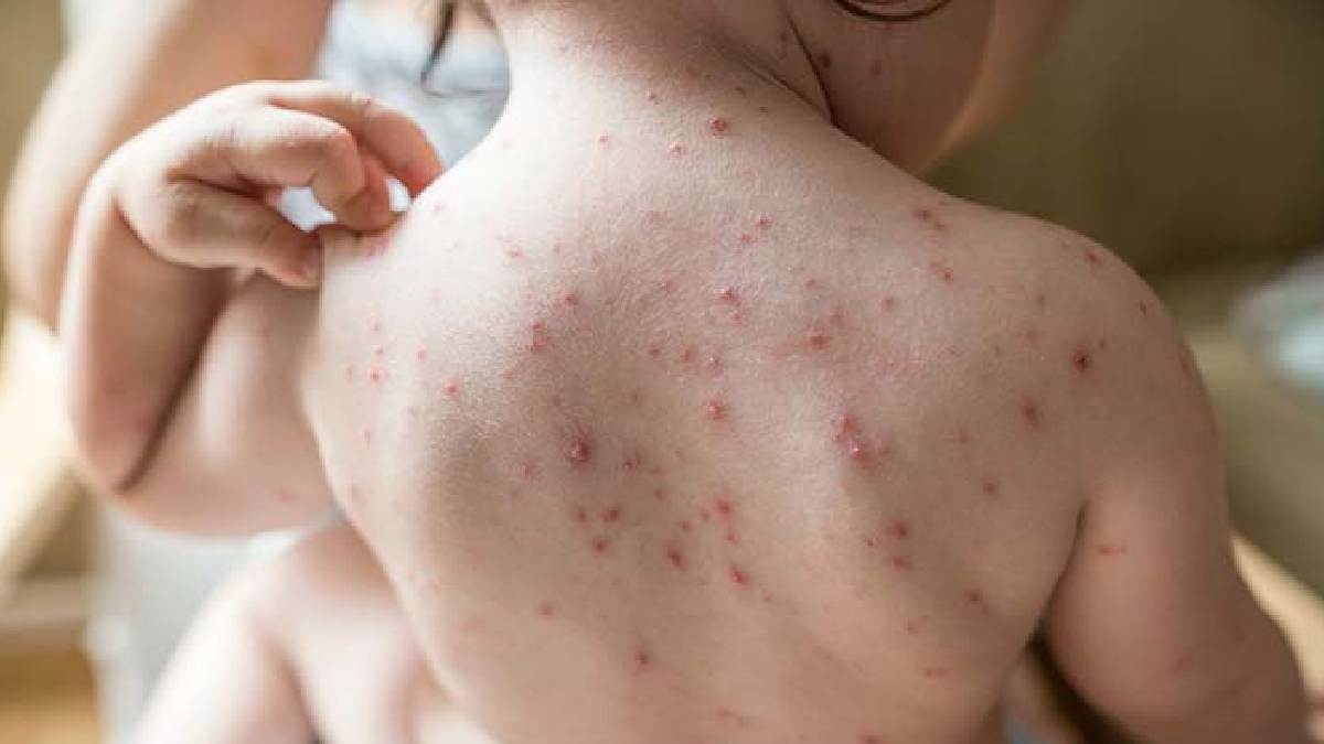 https://www.jagranimages.com/images/newimg/14092025/14_09_2025-chickenpox_24047026.jpg