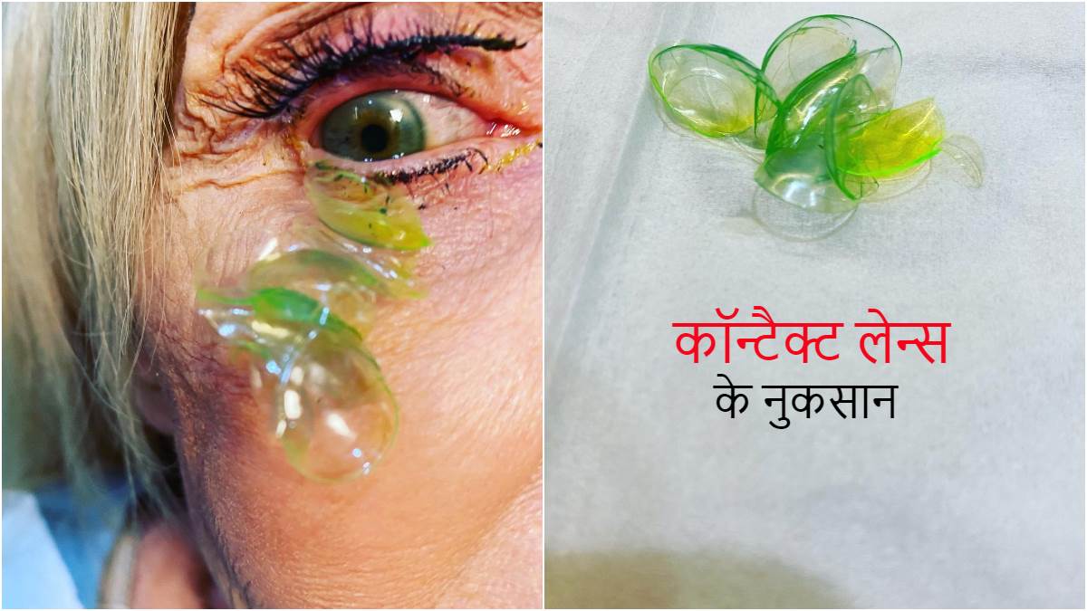 Contact Lenses Side Effects क्या आप भी कॉन्टैक्ट लेन्स लगाकर सो जाते