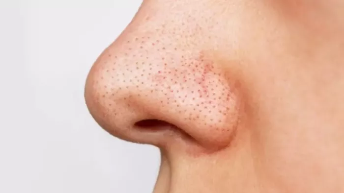 How to remove Blackheads:ब्लैकहेड्स से इस तरह पाएं छुटकारा